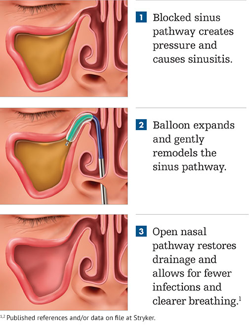 Balloon Dilation for Sinuses and Eustachian Tubes Services